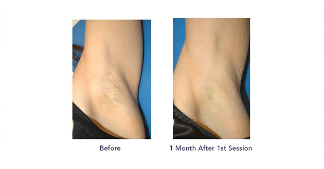 Permanent Hair Removal in Himayat Nagar, Hyderabad