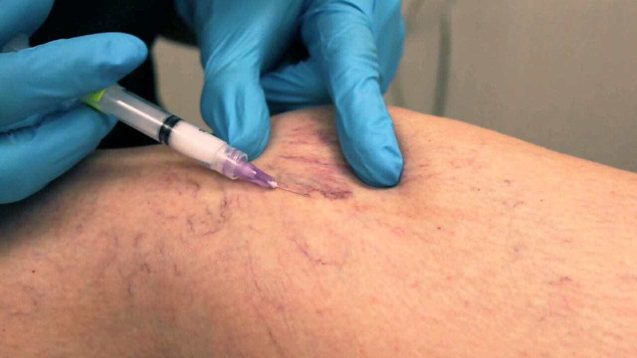 Houston Top Vein Specialists