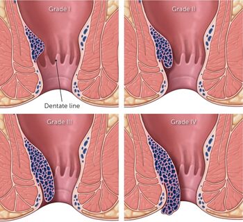 Piles doctor in Patna |Best piles, homeopathic and fistula bawasir doctor and surgeon in Patna | bawasir surgeon in Patna