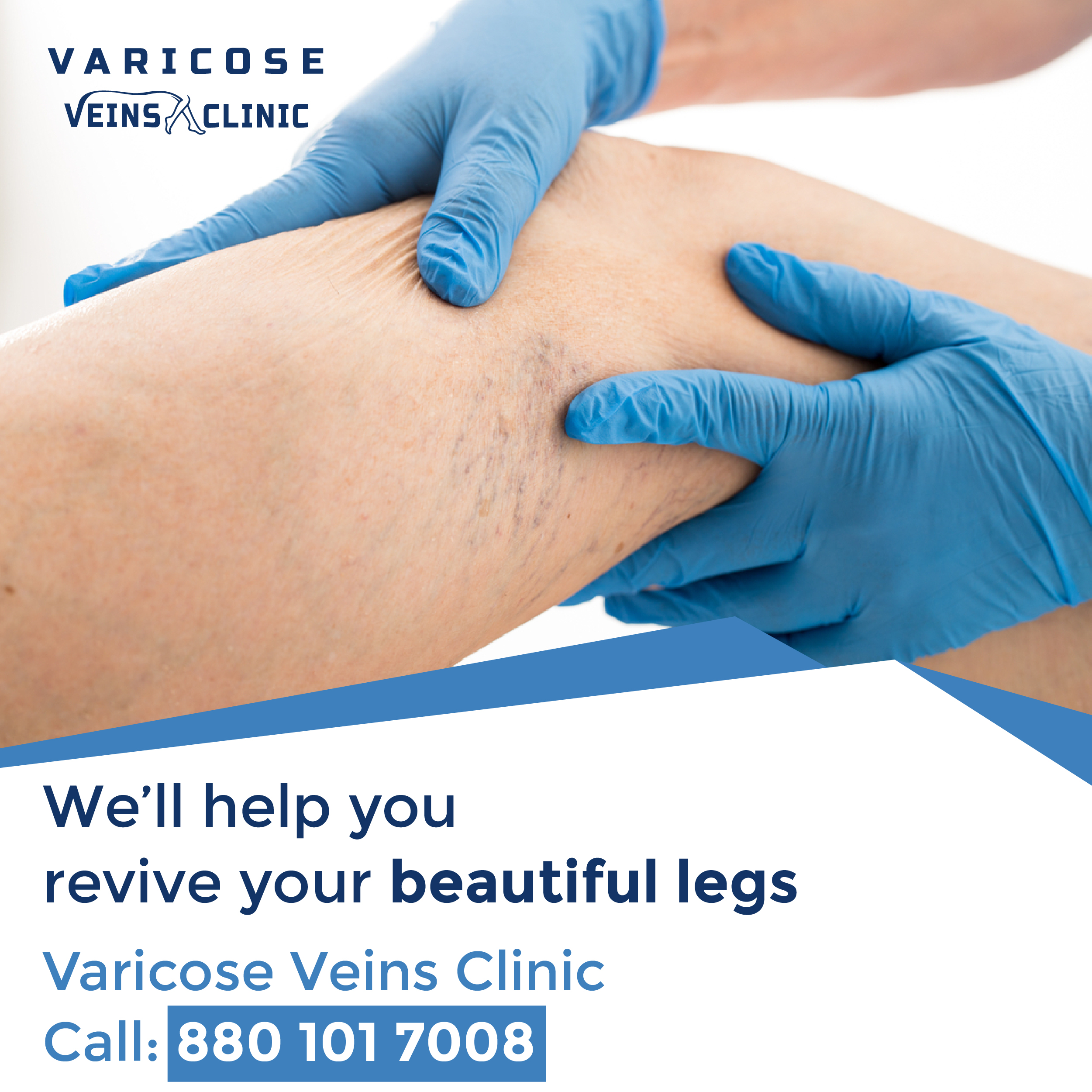Varicose Veins Treatment in Hyderabad at Varicose Veins Clinic. Call us 9108503874