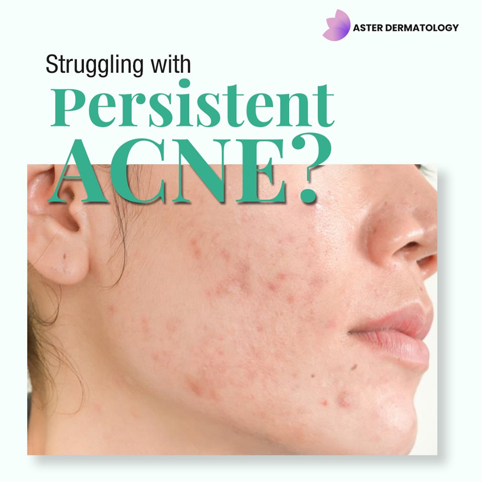 Acne Scars Treatment in Gurgaon @Aster Dermatology
