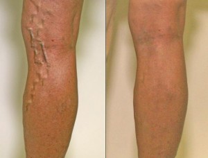 Best Vein Treatment in Houston, TX
