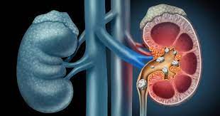 9801040490Best nephrologist in patna | Best nephrology in patnaDr. Vinod Kumar Singh ( EX. Prof. & Head nephrology PMCH ) | Splendid Kidney Hospital & Research Centre