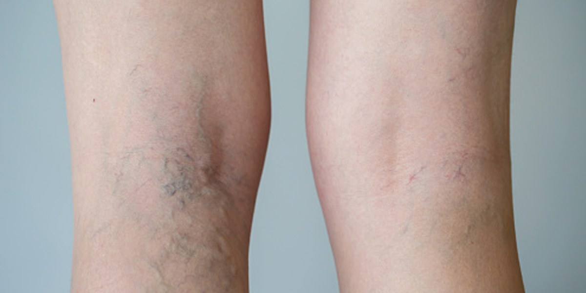 Varicose Veins and Spider Veins: Causes and Treatments