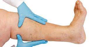 Vein Treatment Specialist Near Me