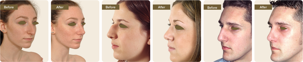 Best Rhinoplasty Surgery in Delhi
