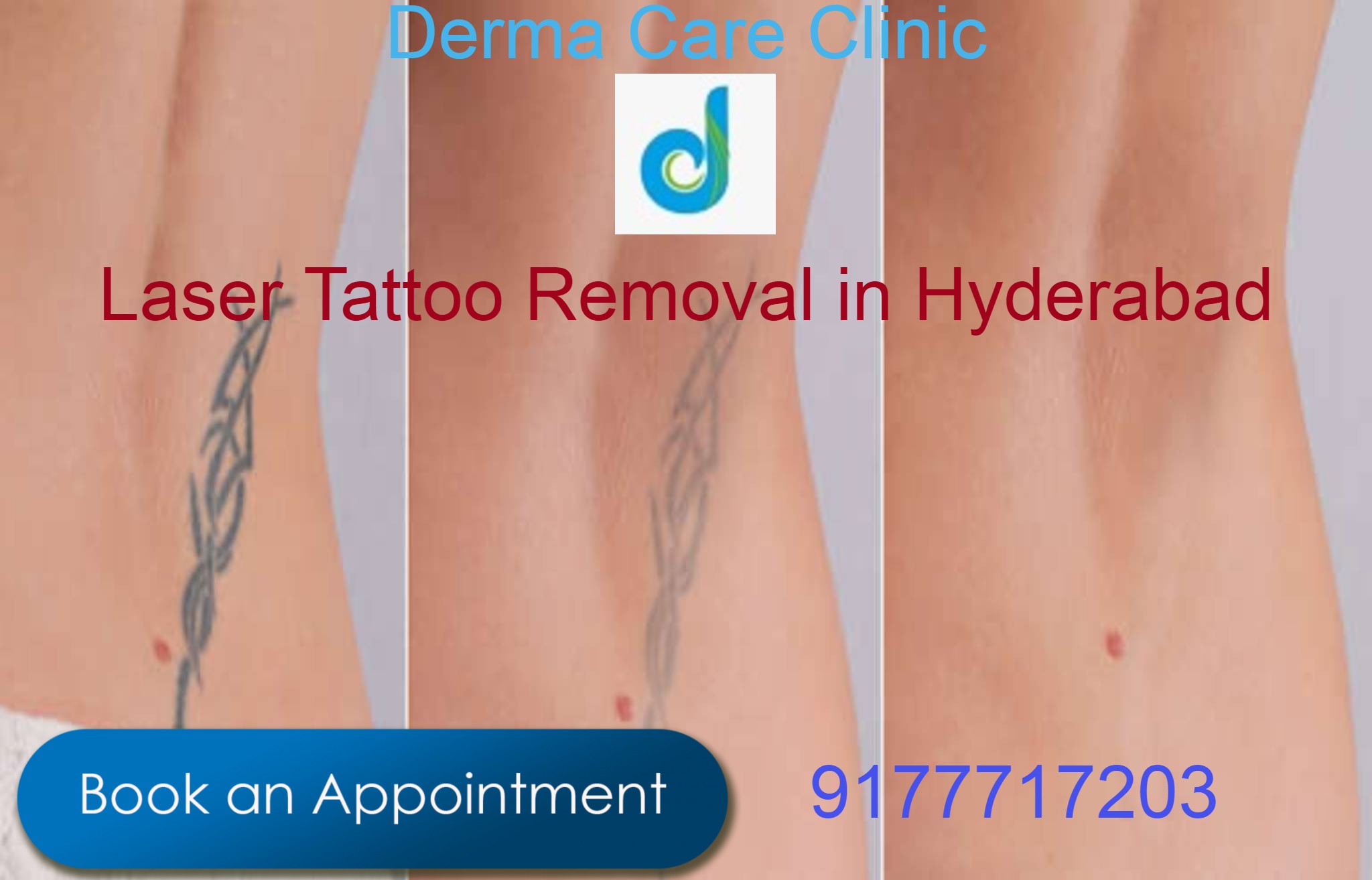 Pimple Treatment in Hyderabad | Acne Treatment in Himayat Nagar