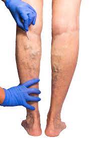 Vein Treatment Center in NJ