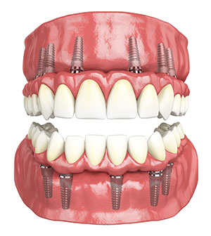 Best Dental Implant Dentist in Udaipur
