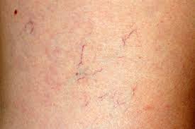 Spider Veins Treatments Near Me