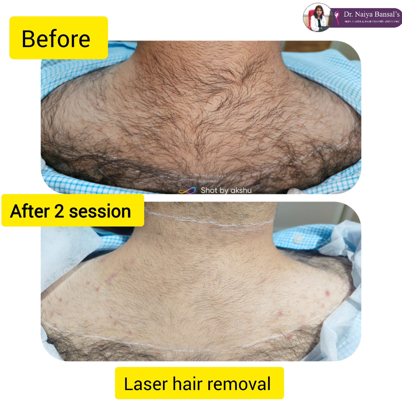 Dr Naiya Bansal - Laser Hair Removal in Chandigarh