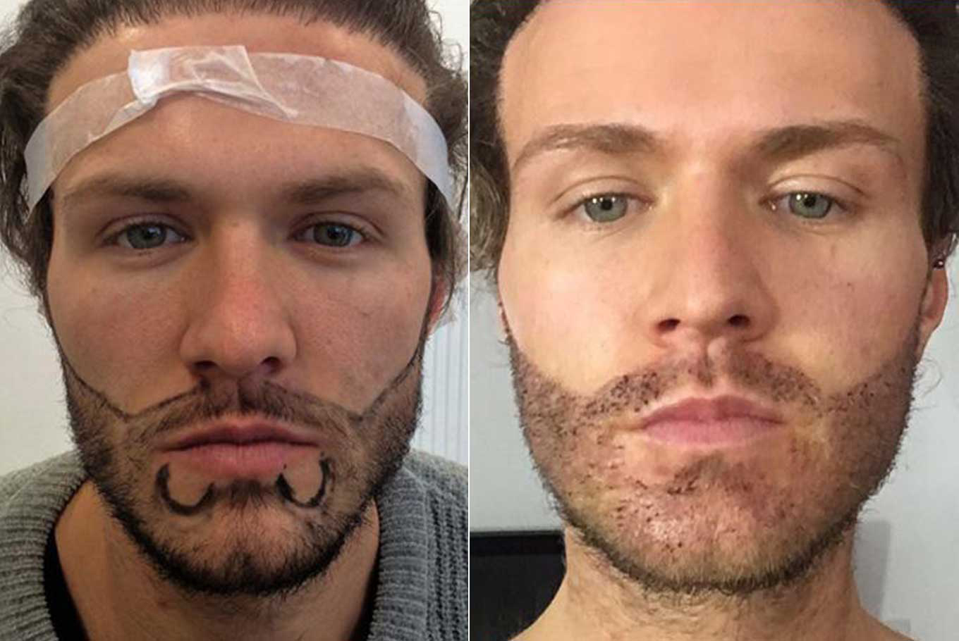 Avail painless and effective beard restoration services