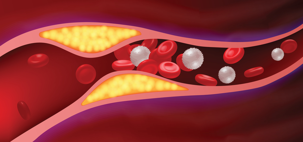 EECP Therapy for 80-90% Blockage: Can It Help You Avoid Bypass Surgery?