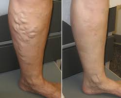 Woodland Park Varicose Vein Treatment Center