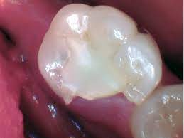 Preparing for Removal of Broken Wisdom Tooth