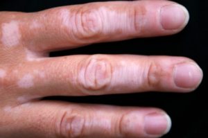 Vitiligo Treatment Cost in Delhi