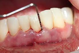 One of The Best Periodontist Houston TX
