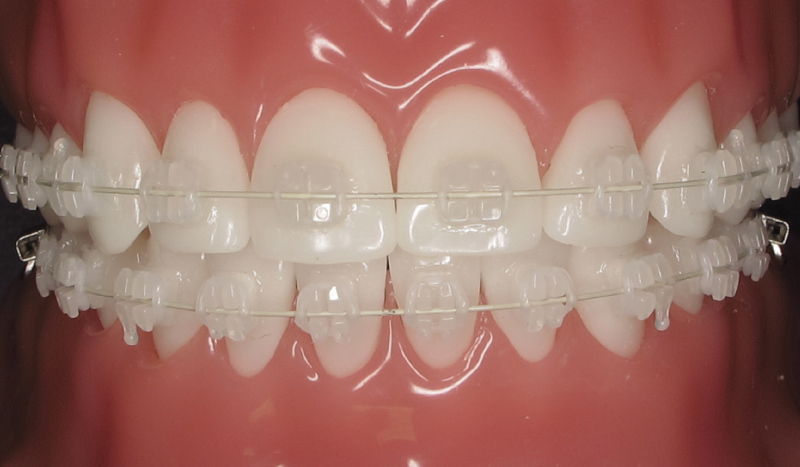 Overbite Correction Solutions For Adults