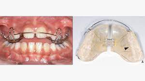 Why Do I Need Bite Turbos With My Braces?