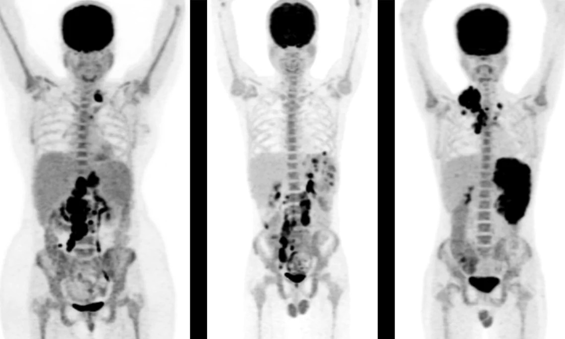 Diagnostic PET CT Scan in Mumbai - Picture This