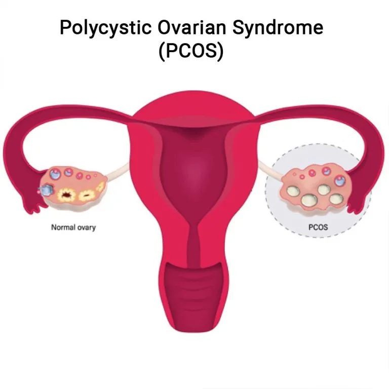 Polycystic Ovarian Syndrome (PCOS) Specialist - NY