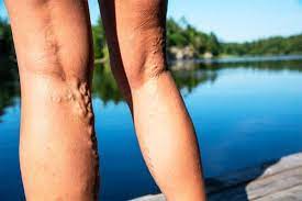 California Varicose Vein Treatment Near Me