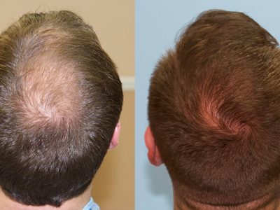 Best Hair Transplant in Himayat Nagar | Derma Care Clinic