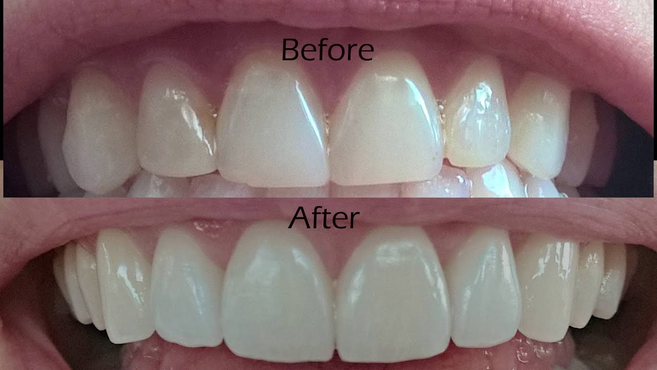 Dental Veneers Cost Houston TX