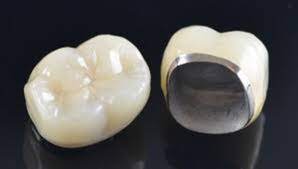 Different Types of Dental Crowns