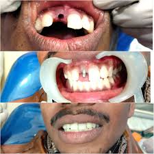 Restorative Dentistry in Houston