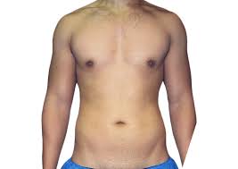 Liposuction in Houston, TX