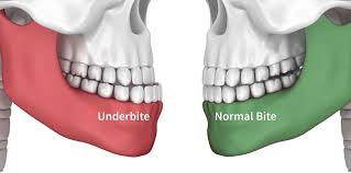 Orthodontist Braces for Adults