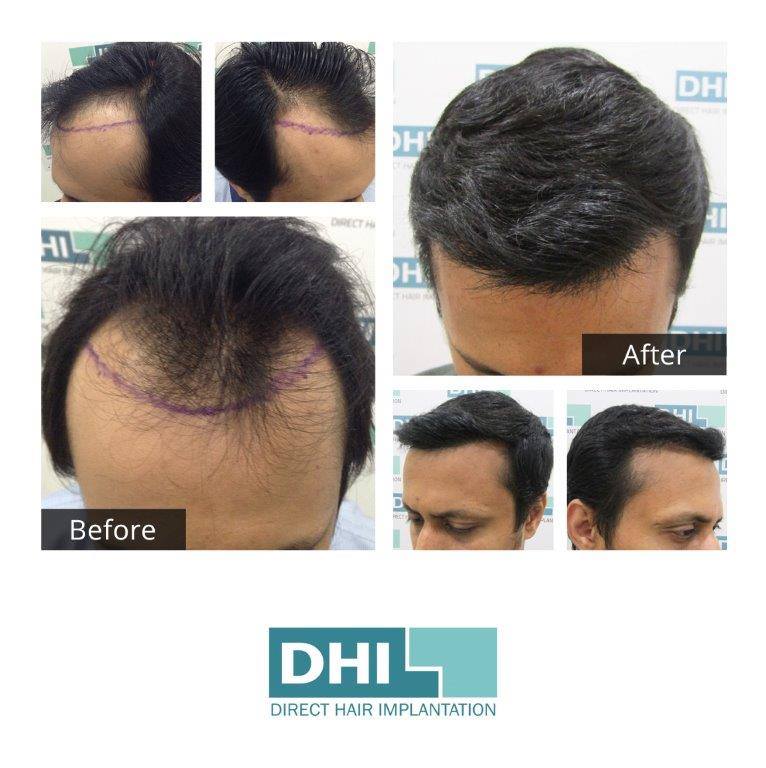 Best Hair Transplant in Gurgaon | DHI India