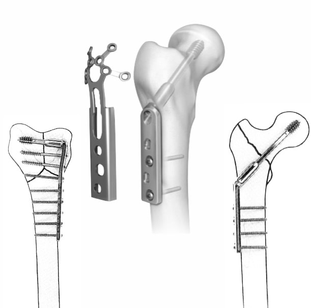 CE-Certified Orthopaedic Implants