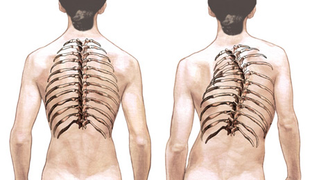 Risk-Free Scoliosis Treatment in India