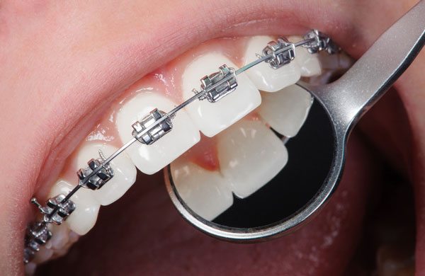 Adult Orthodontics Near Me