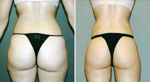 Liposuction Services In Houston, TX