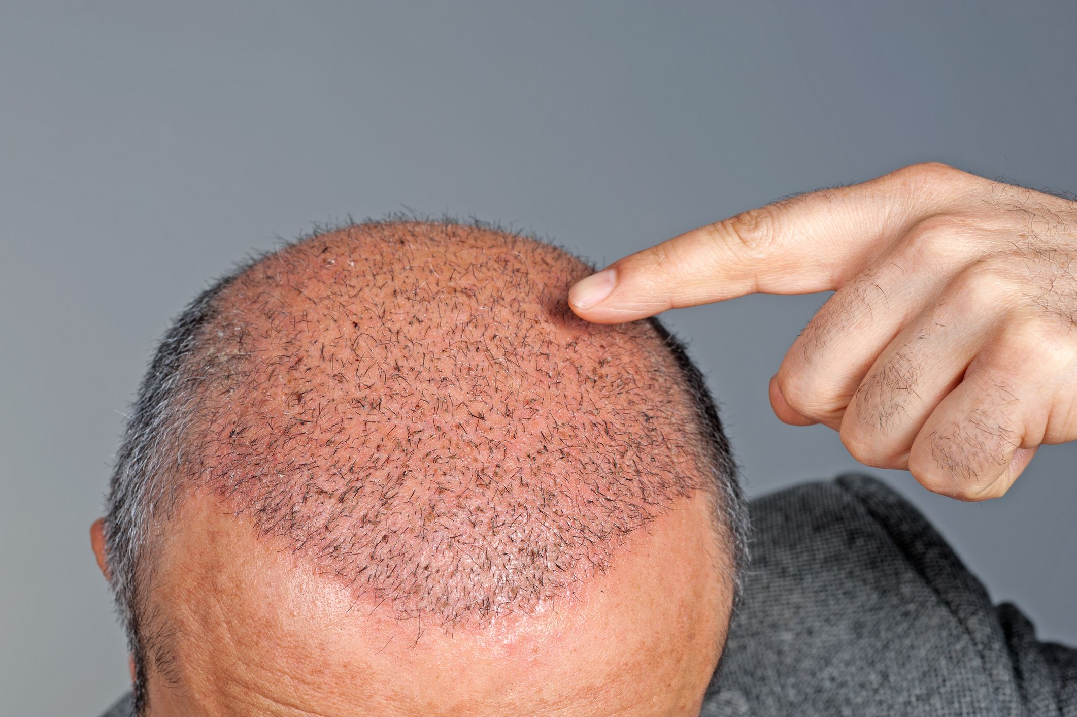 Hair Transplant Cost in Delhi | DHI India