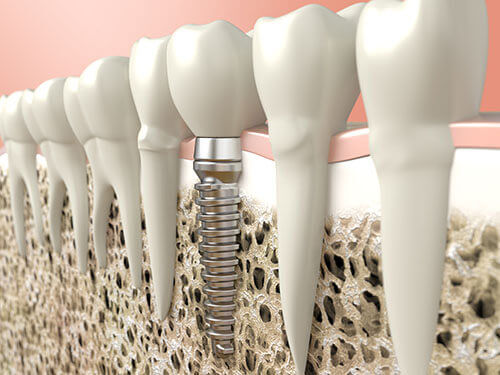 Best Dental Implant Treatment in Gurgaon