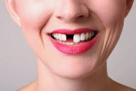 How do Multiple Tooth Dental Implants work?