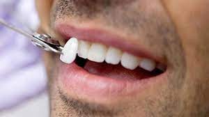 Porcelain Veneers Teeth