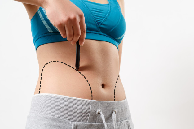 Liposuction Surgery in Delhi