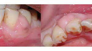 KöR Teeth Whitening Near me