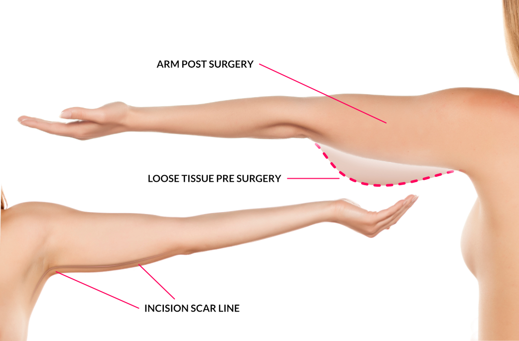 Arm Lift Procedure in Delhi | Dr Rajat Gupta