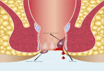 Piles doctor in Patna |Best piles, homeopathic and fistula bawasir doctor and surgeon in Patna | bawasir surgeon in Patna 2