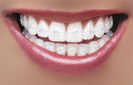 How long does a Root Canal take?