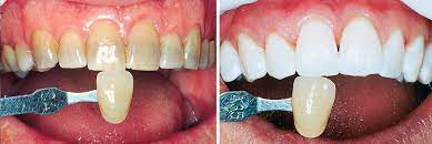 Teeth Whitening Dentist Near Me