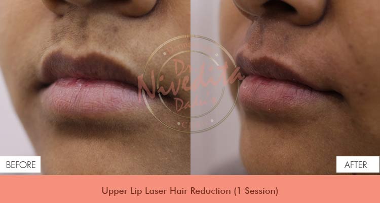 Best Doctor For Laser Hair Removal in Delhi