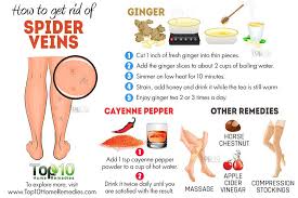 How To Remove Varicose Veins?