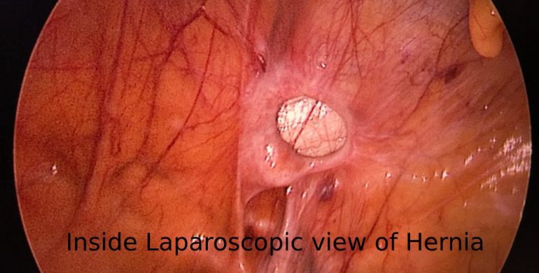 Best Surgeon for Hernia Repair in Delhi